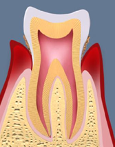 歯周病