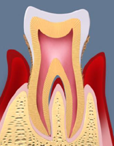 歯周病
