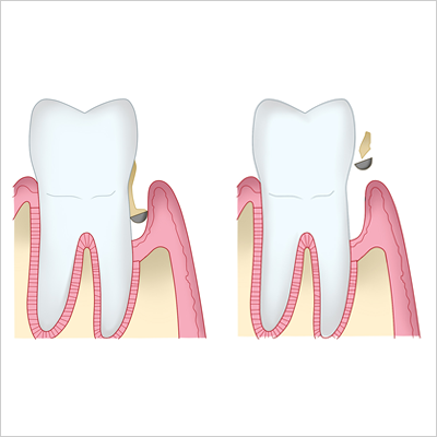 歯根膜を再生する