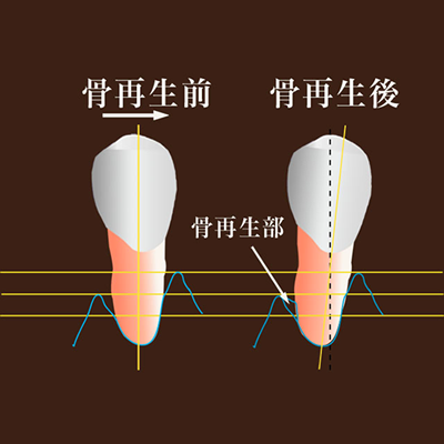 歯根膜が再生し、次いで、骨芽細胞、セメント質細胞が再生する